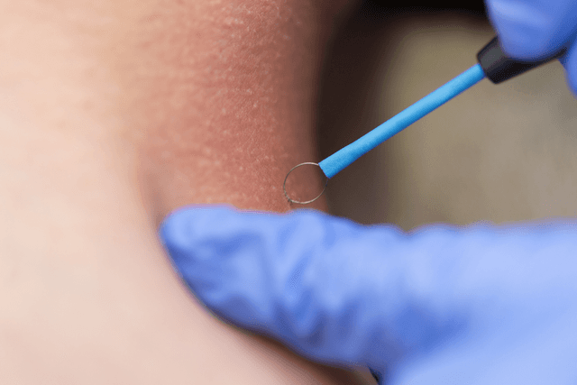 Image Electrosurgical Devices Image 16